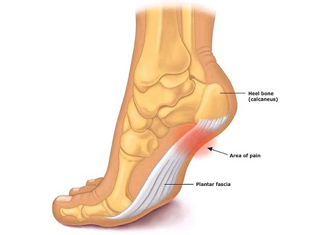 Diagram of Heel pain and Plantar Fasciitis